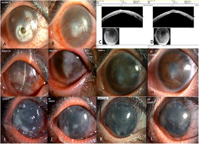 Case Report: Allogenic Simple Limbal Epithelial Transplantation From a Human Leukocyte Antigen-Matched Living Related Donor to Treat Bilateral Corneal Chemical Burns Post Laser-Assisted in situ Keratomileusis